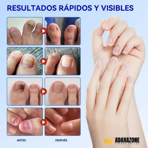 Parche Nocturno para Uñas Dañadas .